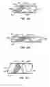 Fig. 03 - Endoluminal filter having enhanced echogenic properties