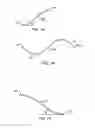 Fig. 06 - Endoluminal filter having enhanced echogenic properties