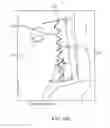Fig. 44 - SYSTEM FOR PROVIDING SURGICAL ACCESS