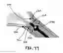 Fig. 71 - URETHRAL ANASTOMOSIS DEVICE AND METHOD