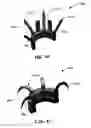 Fig. 73 - URETHRAL ANASTOMOSIS DEVICE AND METHOD