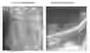 Fig. 01 - NEURAL IMPLANT