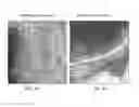 Fig. 03 - NEURAL IMPLANT