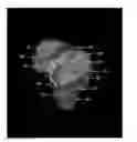 Fig. 01 - System and method for image segmentation in generating computer models of a joint to undergo arthroplasty