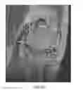 Fig. 09 - System and method for image segmentation in generating computer models of a joint to undergo arthroplasty