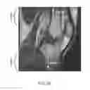 Fig. 12 - System and method for image segmentation in generating computer models of a joint to undergo arthroplasty