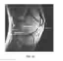 Fig. 14 - System and method for image segmentation in generating computer models of a joint to undergo arthroplasty