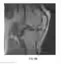 Fig. 16 - System and method for image segmentation in generating computer models of a joint to undergo arthroplasty