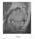 Fig. 17 - System and method for image segmentation in generating computer models of a joint to undergo arthroplasty