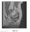 Fig. 19 - System and method for image segmentation in generating computer models of a joint to undergo arthroplasty