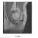 Fig. 20 - System and method for image segmentation in generating computer models of a joint to undergo arthroplasty