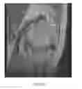 Fig. 21 - System and method for image segmentation in generating computer models of a joint to undergo arthroplasty
