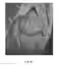 Fig. 22 - System and method for image segmentation in generating computer models of a joint to undergo arthroplasty