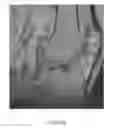 Fig. 26 - System and method for image segmentation in generating computer models of a joint to undergo arthroplasty