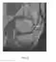 Fig. 28 - System and method for image segmentation in generating computer models of a joint to undergo arthroplasty