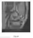 Fig. 29 - System and method for image segmentation in generating computer models of a joint to undergo arthroplasty