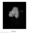 Fig. 31 - System and method for image segmentation in generating computer models of a joint to undergo arthroplasty