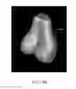 Fig. 37 - System and method for image segmentation in generating computer models of a joint to undergo arthroplasty