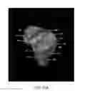 Fig. 40 - System and method for image segmentation in generating computer models of a joint to undergo arthroplasty