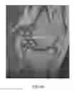 Fig. 52 - System and method for image segmentation in generating computer models of a joint to undergo arthroplasty