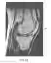 Fig. 56 - System and method for image segmentation in generating computer models of a joint to undergo arthroplasty