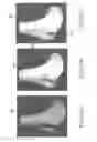 Fig. 57 - System and method for image segmentation in generating computer models of a joint to undergo arthroplasty
