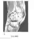 Fig. 62 - System and method for image segmentation in generating computer models of a joint to undergo arthroplasty