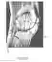 Fig. 63 - System and method for image segmentation in generating computer models of a joint to undergo arthroplasty