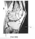 Fig. 64 - System and method for image segmentation in generating computer models of a joint to undergo arthroplasty