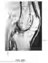 Fig. 66 - System and method for image segmentation in generating computer models of a joint to undergo arthroplasty