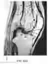 Fig. 67 - System and method for image segmentation in generating computer models of a joint to undergo arthroplasty