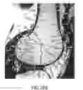Fig. 72 - System and method for image segmentation in generating computer models of a joint to undergo arthroplasty