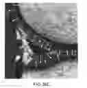 Fig. 73 - System and method for image segmentation in generating computer models of a joint to undergo arthroplasty