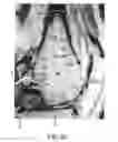Fig. 76 - System and method for image segmentation in generating computer models of a joint to undergo arthroplasty