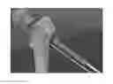 Fig. 01 - Bone drill guides and methods of use thereof
