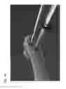 Fig. 27 - Bone drill guides and methods of use thereof