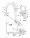 Fig. 09 - Method and apparatus for orthopedic fixation