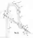 Fig. 13 - Method and apparatus for orthopedic fixation