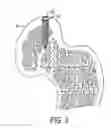 Fig. 06 - METHODS OF USING WOVEN RETENTION DEVICES AND SYSTEMS