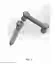 Fig. 03 - PressOn Pedicle Screw Variations