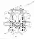Fig. 01 - Adjustable spinous process spacer device and method of treating spinal disorders