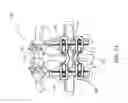 Fig. 02 - Adjustable spinous process spacer device and method of treating spinal disorders