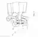Fig. 04 - Adjustable spinous process spacer device and method of treating spinal disorders