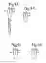 Fig. 16 - Dynamic spinal stabilization assemblies, tool set and method