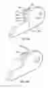 Fig. 12 - Pectus bar stabilizer