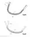 Fig. 14 - Expandable Bone Implant