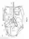 Fig. 10 - Deployment mechanisms for surgical instruments