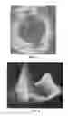 Fig. 05 - Patient Selectable Joint Arthroplasty Devices and Surgical Tools