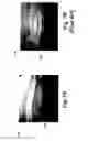 Fig. 08 - Hernia patch