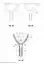 Fig. 03 - Coupling a body conduit to tissue